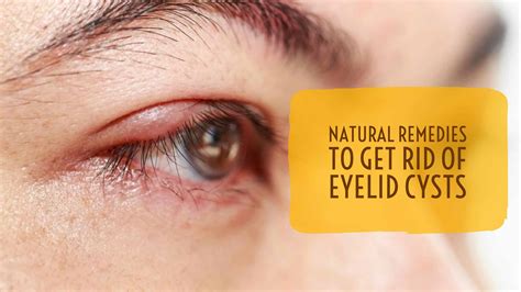 Natural Remedies To Get Rid Of Eyelid Cysts