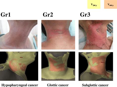 Representative Images Of Patients With Dermatitis Of Various Grades
