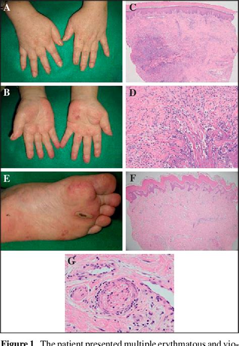Figure 1 From Palisaded Neutrophilic And Granulomatous Dermatitis In A