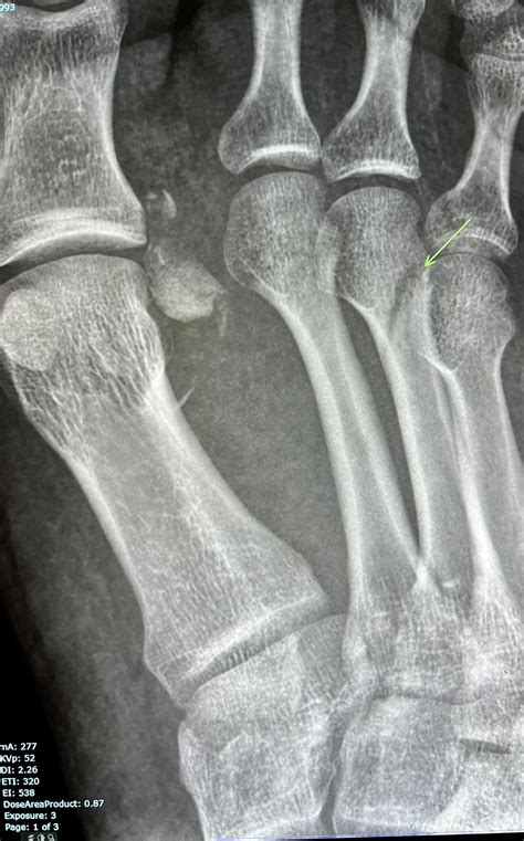 Sameer Raniga On Twitter One View Is No View 3rd Metatarsal Fracture