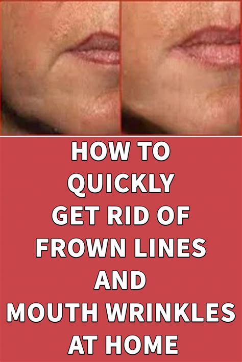 How To Quickly Get Rid Of Frown Lines And Mouth Wrinkles At Home