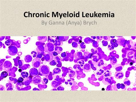 Chronic Myeloid Leukemia Symptoms Stages And Treatment Ppt