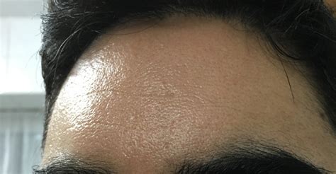 Here is why you're experiencing breakouts only on your forehead. Dramatic change to skin texture and pores after Accutane ...