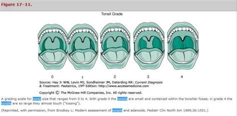 Tonsillar Grading