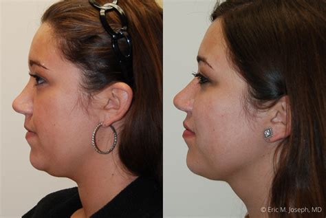 Eric M Joseph Md Chin And Neck Before And After Neck Liposuction For