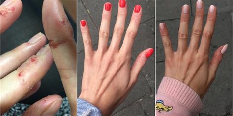 How I Stopped Biting My Fingers And Nails After 15 Years