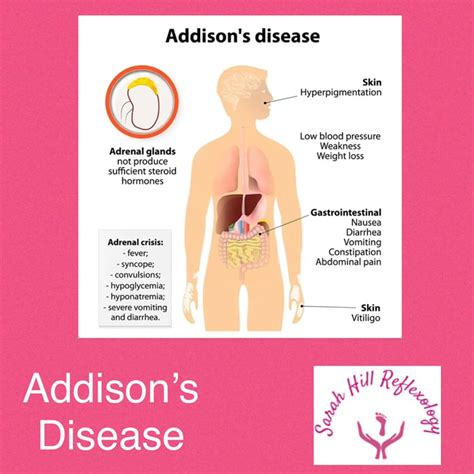 Addison S Disease Uk
