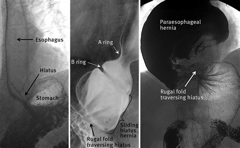 The Diagnosis And Management Of Hiatus Hernia The Bmj