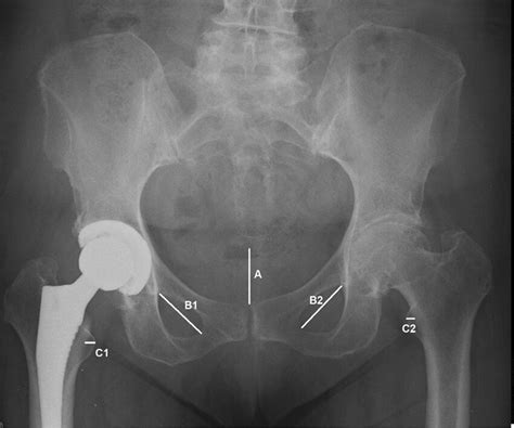 Anteroposterior Pelvic Radiograph Performed After Right Hip Replacement