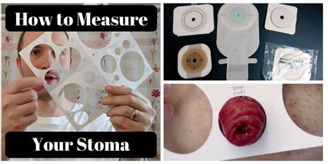 How To Measure Your Stoma Ostomy Tips Veganostomy