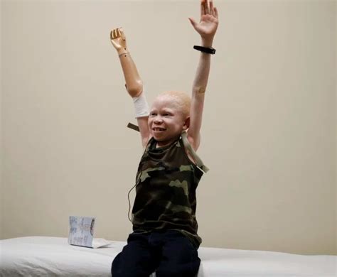 Tanzanian Albino Children Hunted For Their Limbs Get Another Chance At