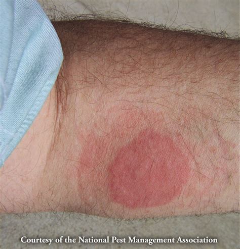 Bed Bugs Do Not Transmit Diseases But Bed Bug Bites Can Become Red