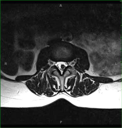 Lumbar Spinal Schwannoma Neuro Mr Case Studies Ctisus Ct Scanning