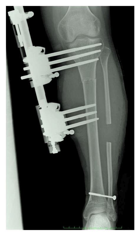 Radiograph Of The Left Tibia After Lengthening Operation Download