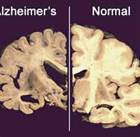 Neurologie Wann Eine Normale Vergesslichkeit Zur Demenz Wird Welt