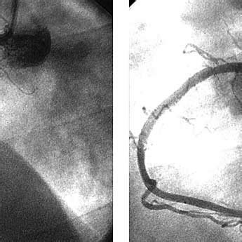 Common ECG Features Distinguishing The Culprit Artery In Acute Inferior