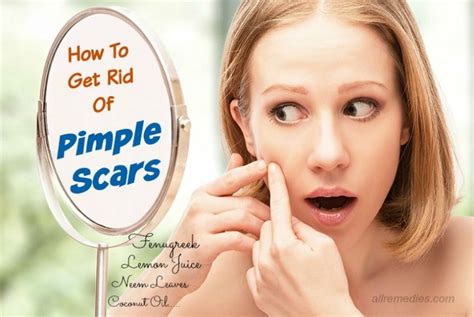 20 Fast Tips How To Get Rid Of Pimple Scars Naturally