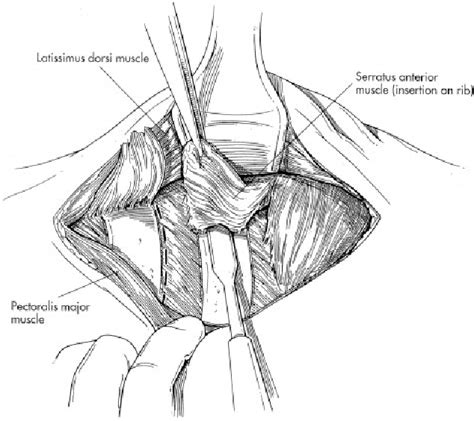 Figure 2 From Pain And Physical Function Are Similar Following Axillary