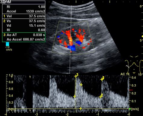 Filedoppler Ultrasound Of Systolic Velocity Vs Diastolic Velocity