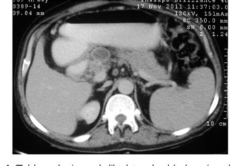 Figure 1 From Rosai Dorfman Disease With Exclusive Intra Abdominal