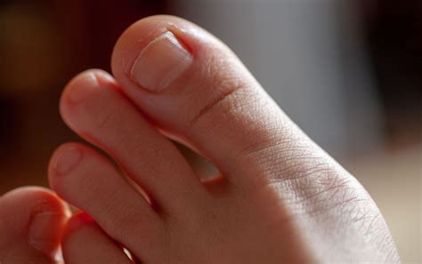Blister Under Your Toenail Heres How To Treat It