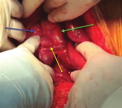 An Intraoperative Photo Showing A 22 Mm Dilated Common Bile Duct Green