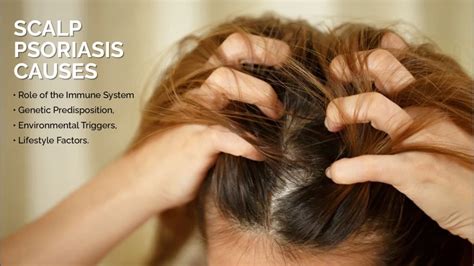 Scalp Psoriasis Causes Treatment And Prevention Easy Peasy Skincare