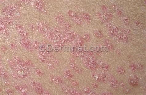 Psoriasis Guttate Photo Skin Disease Pictures Psoriasis Guttate