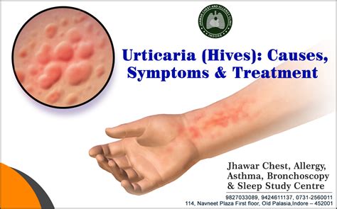 Urticaria Hives Causes Symptoms And Treatment