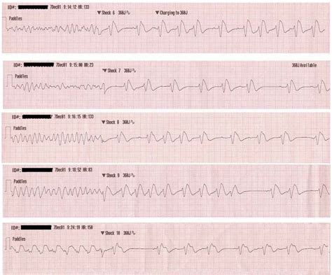 Vfib is the most serious arrhythmia and is an uncontrolled, irregular heartbeat. Ventricular Fibrillation (VF) • LITFL • ECG Library Diagnosis