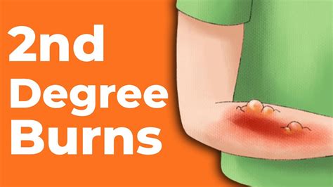 2nd Degree Burns How To Treat Them Wound Care Oc Youtube