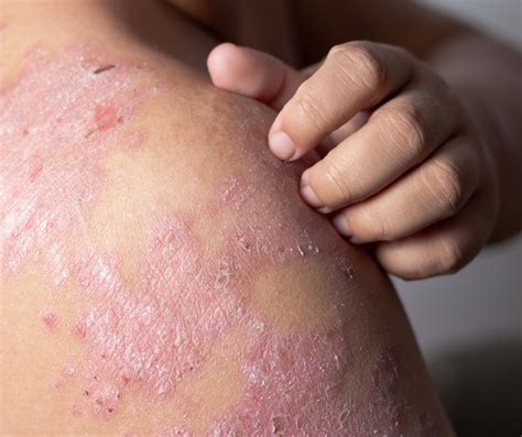 Sint Tico Imagen Fotos De Dermatitis En Las Manos Alta Definici N Completa K K