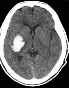 Nontraumatic Intracerebral And Subarachnoid Hemorrhage Clinical Gate