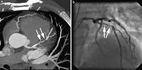 Ct Angiography Heart