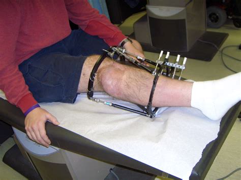 What Is Limb Lengthening Surgery And How Does It Work