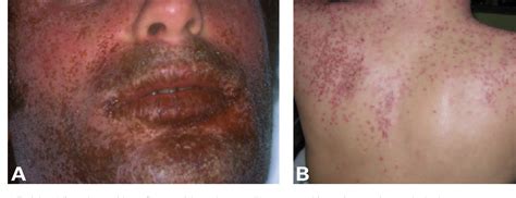 Figure 1 From Eczema Herpeticum During Treatment Of Atopic Dermatitis