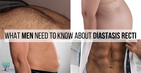 What Men Need To Know About Diastasis Recti The Tummy Team Online The