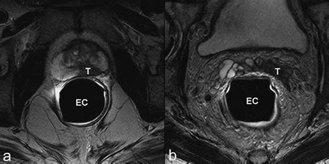 Magnetic Resonance Imaging Mri Anatomy Of The Prostate And Application Of Mri In Radiotherapy
