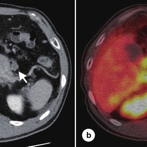 Ct Scan And Pet Ct Scan A Intravenous Contrast Enhanced Ct Scans