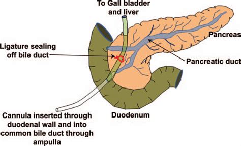 —surgical Cannulation Of The Common Bilepancreatic Duct And Ligation