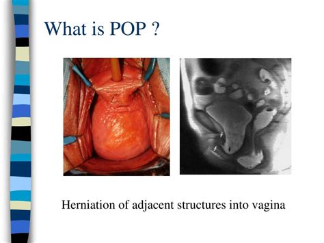 PPT Pelvic Organ Prolapse Overview Of Causes And Surgical Options PowerPoint Presentation