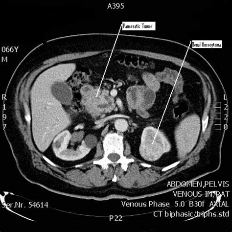 Ct Scan Of The Abdomen Showing The Pancreatic Tumor And The Left Renal