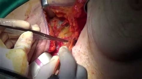 Axillary Lymph Node Dissection Youtube