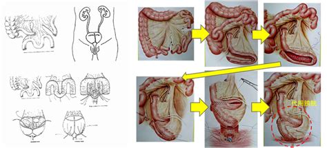 クライブは膀胱が小さ, 膀胱はそのままだわ, 膀胱に対するものがあります, 俺の膀胱はポット並みのサイズだ, つまり膀胱結石を除去しているところですが. 膀胱がんの治療について | 泌尿器科 | 東京国際大堀病院