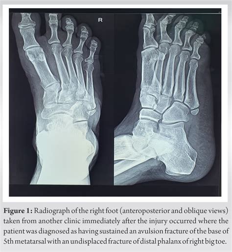 Red Herring In Orthopedics A Case Report On Painful Os Vesalianum