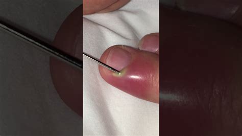 Awesome Pus Filled Finger Youtube