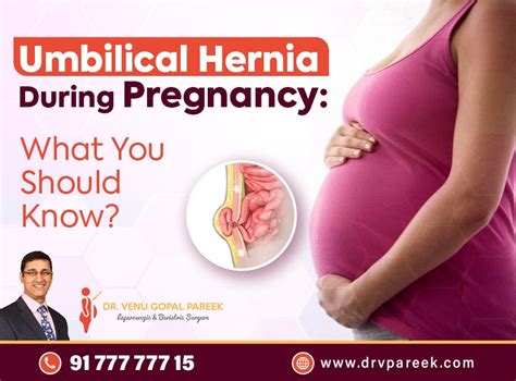 Umbilical Hernia During Pregnancy What You Should Know