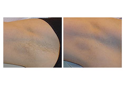 Laser Hair Removal In San Diego Ca Treatments Lasers Side Effects
