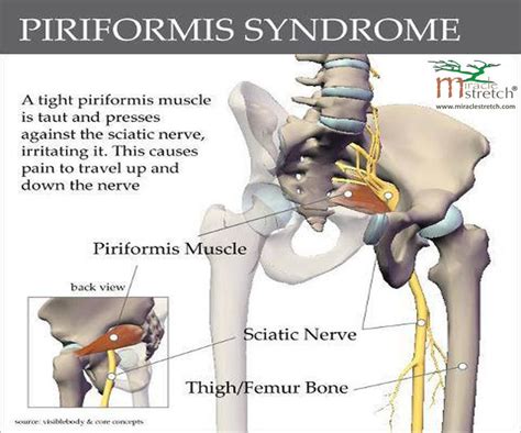 Bend forward at the hips bringing the kettlebell to the floor while you slightly bend your knees and keep your back straight. 164 best Help with Piriformis Syndrome images on Pinterest ...