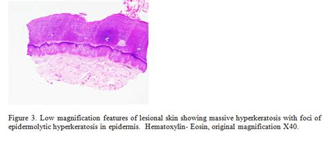 Epidermal Nevus With Epidermolytic Hyperkeratosis A Case Report